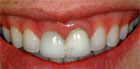 tooth whitening in new york city