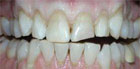 porcelain veneers in new york city