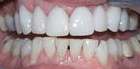procelain veneers in new york city