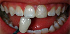 tooth whitening in new york city